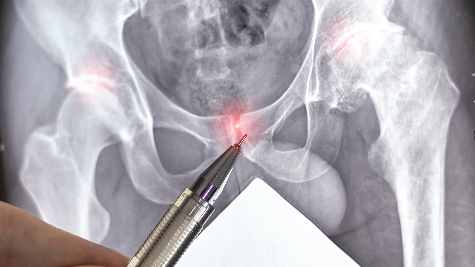 复杂盆腔囊肿不全是卵巢肿瘤